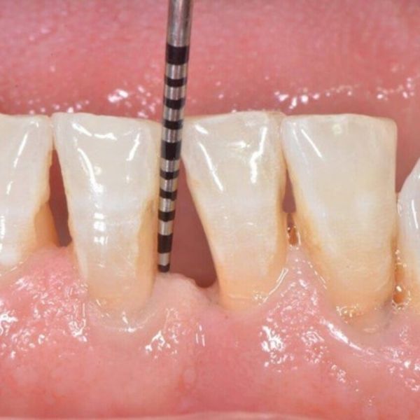cura malattia parodontale smile center dentista verona