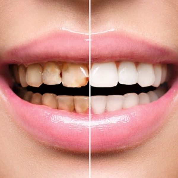 faccette dentali smile center dentista verona