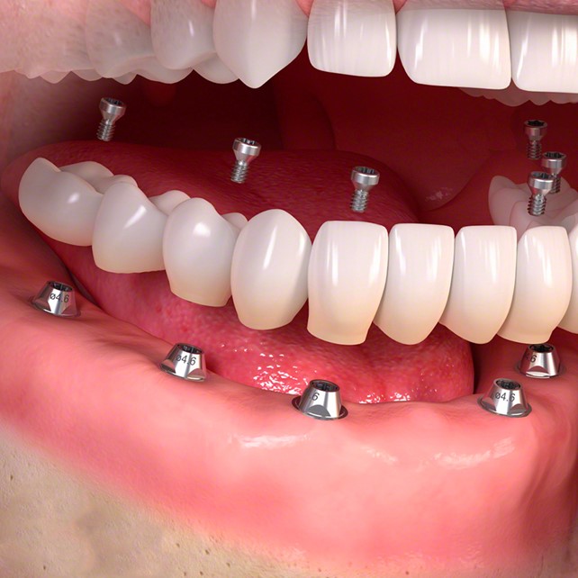 intervento di implantologia dentale